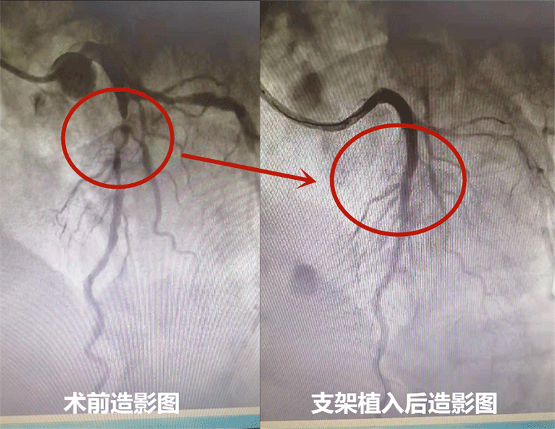 三根冠狀動(dòng)脈血管嚴(yán)重狹窄  樂城心內(nèi)科完成一臺復(fù)雜冠脈支架植入術(shù)